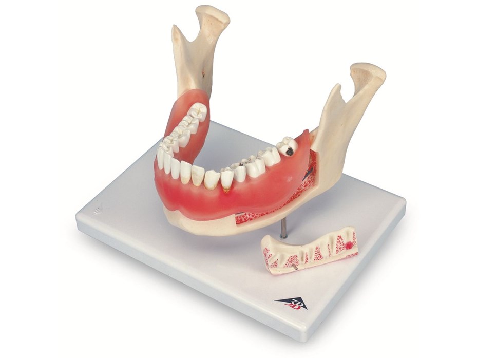 Dental Disease Model.jpg