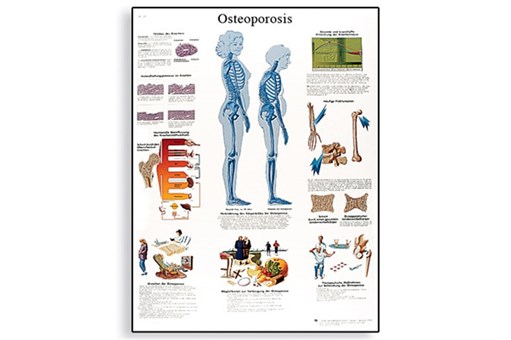 Osteoporosis Chart.jpg