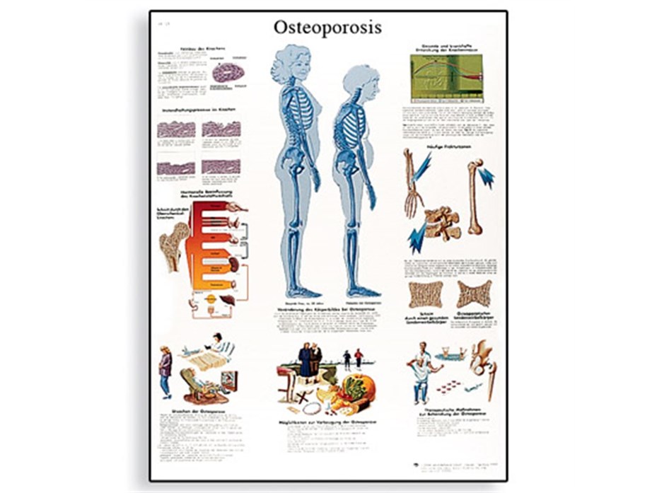 Osteoporosis Chart.jpg